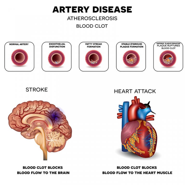 New York Carotid Artery Blockage Stroke Prevention Procedures Nyc